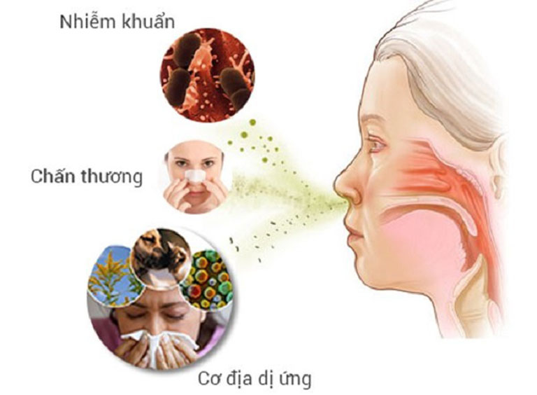 Có nhiều nguyên nhân gây bệnh viêm mũi dị ứng