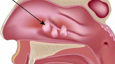 Viêm xoang Polyp mũi là gì? Dấu hiệu nhận biết và cách điều trị hiệu quả