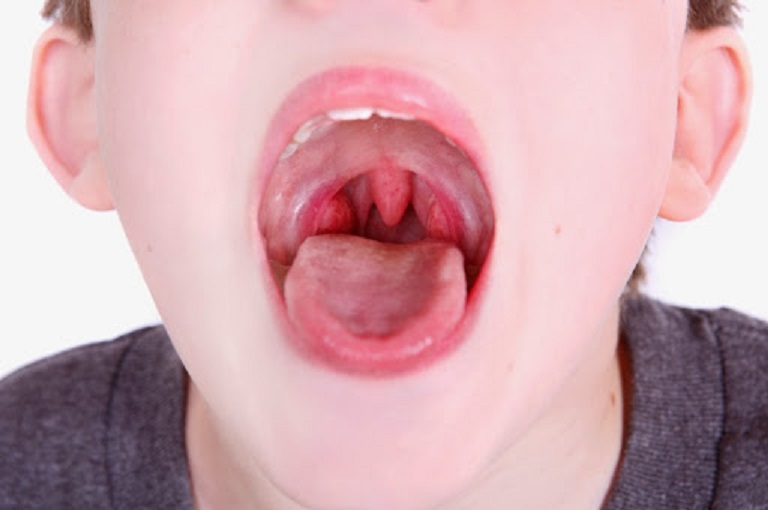 Trẻ bị viêm amidan mãn tính là tình trạng amidan của trẻ bị viêm nhiễm ở cấp độ nặng