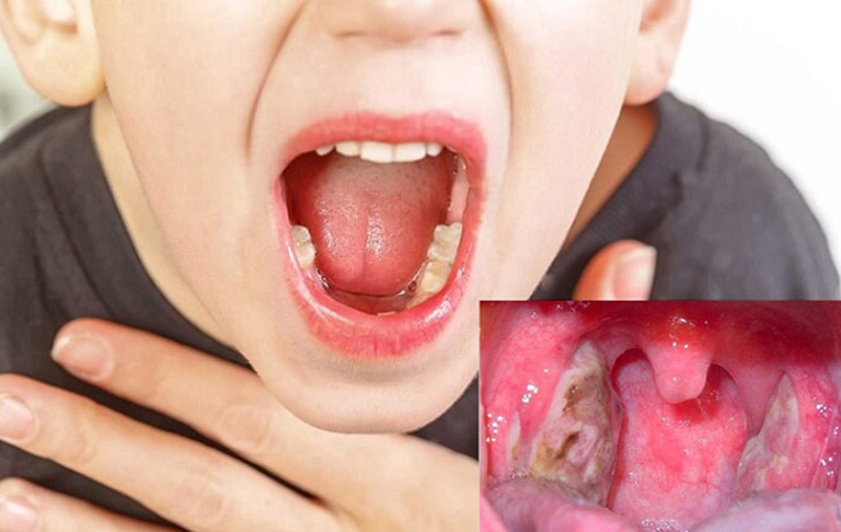 Viêm họng ở trẻ có thể gây ra nhiều biến chứng nguy hiểm