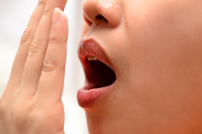 Hơi thở có mùi là một trong những triệu chứng của viêm amidan 