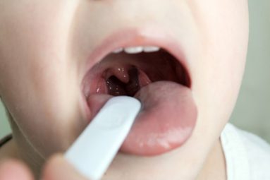 Viêm amidan hốc mủ ở trẻ