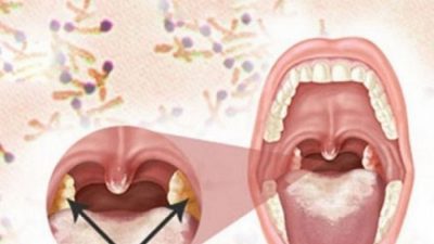 Viêm họng bạch hầu là bệnh lý rất nguy hiểm, có tính lây lan nhanh và có thể gây tử vong