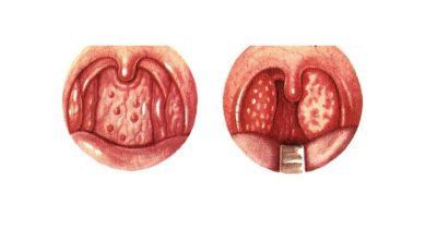 Hình ảnh các hạt viêm trong họng của người bệnh
