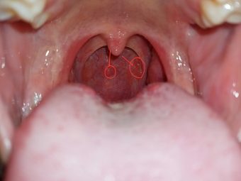 Viêm họng hạt gây nổi hạch là một trong những triệu chứng của bệnh lý viêm họng mãn tính