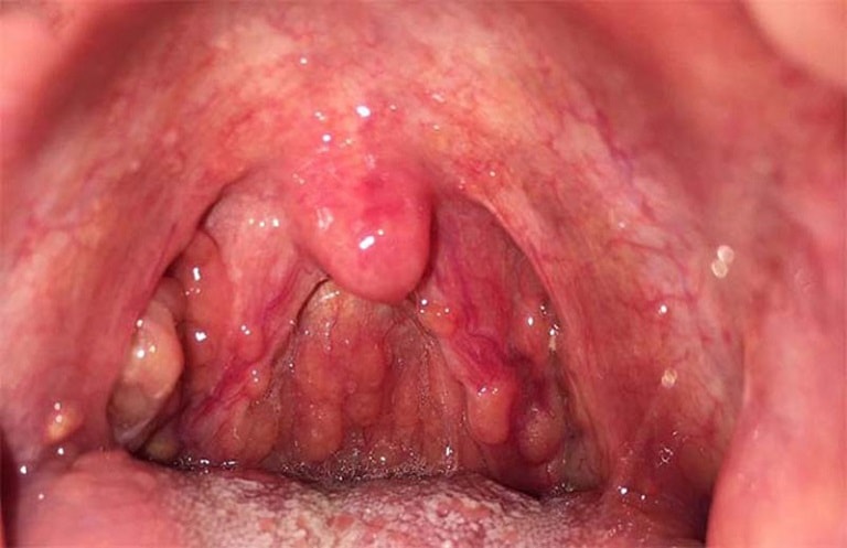 Viêm họng hạt là bệnh lý đường hô hấp xảy ra khi người bệnh bị viêm họng kéo dài, thường xuyên tái phát