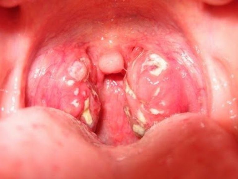 Viêm họng loét là tình trạng cổ họng bị viêm loét, khu vực viêm có thể kéo dài đến dây thanh quản hoặc thực quản