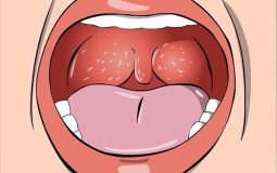Viêm họng mãn tính là bệnh lý hô hấp rất thường gặp