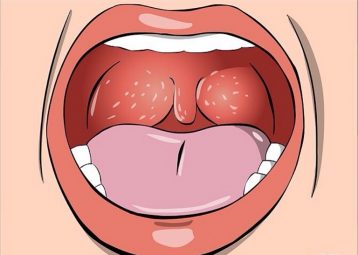 Viêm họng mãn tính là bệnh lý hô hấp rất thường gặp