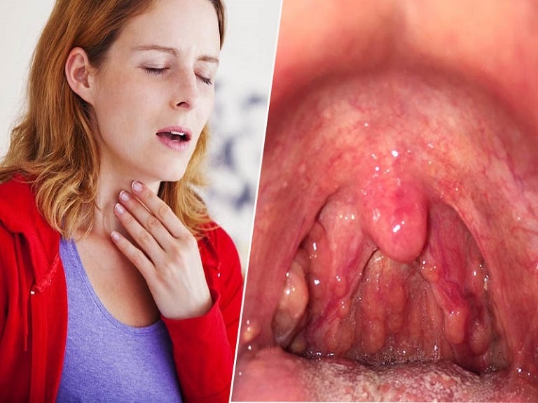 Khi bị viêm họng tái phát nhiều lần nhưng không điều trị có thể hình thành mủ trong họng