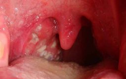 Viêm họng mủ là tình trạng nhiễm trùng đường hô hấp nặng, xảy ra khi bệnh viêm họng kéo dài