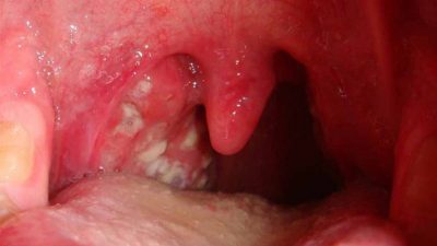 Viêm họng mủ là tình trạng nhiễm trùng đường hô hấp nặng, xảy ra khi bệnh viêm họng kéo dài