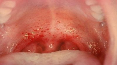 Viêm họng xuất huyết hay còn gọi là viêm mũi họng xung huyết là một tình trạng viêm họng cấp tính khá phổ biến