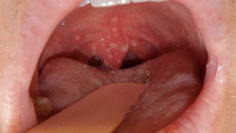 Ung thư vòm họng là một trong những biến chứng nguy hiểm của viêm loét họng