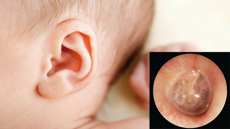 Trẻ em là đối tượng mắc bệnh viêm tai giữa nhất