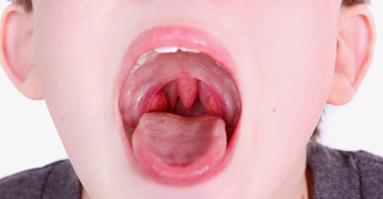 Bệnh viêm họng gây ra nhiều ảnh hưởng cho sức khỏe