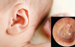 Bệnh viêm tai giữa chảy mủ