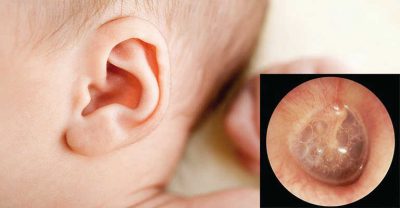 Bệnh viêm tai giữa chảy mủ