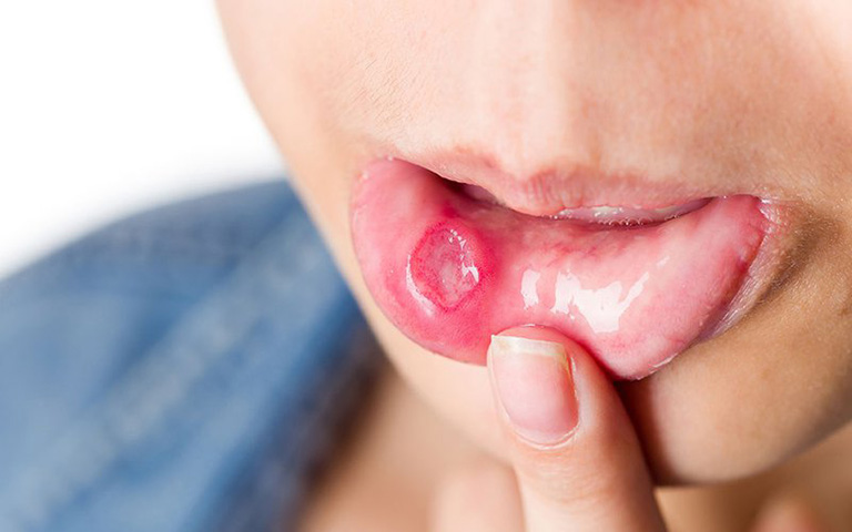 Ho đau rát họng có thể do bệnh lậu ở miệng