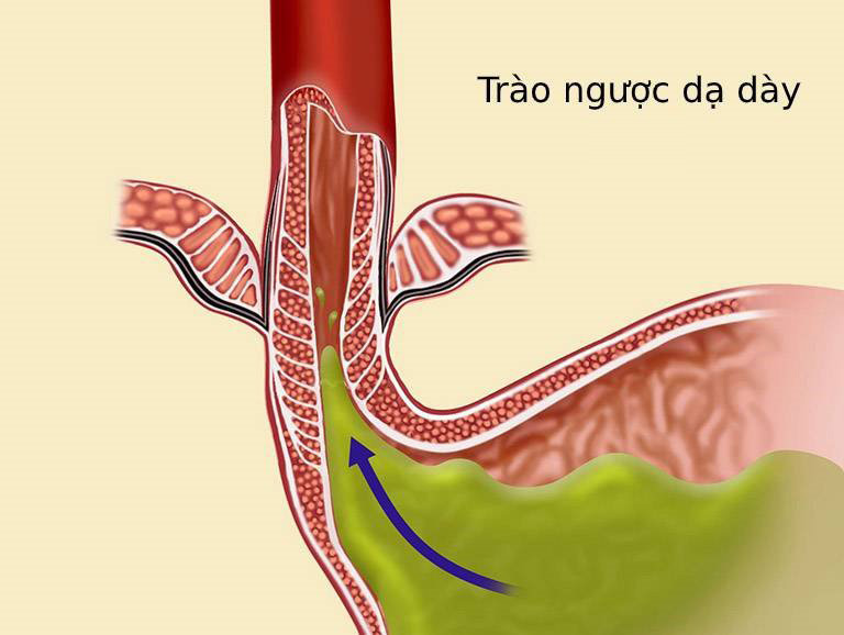 Dịch axit dạ dày trào lên trong bệnh trào ngược dạ dày có thể gây kích ứng niêm mạc cổ họng