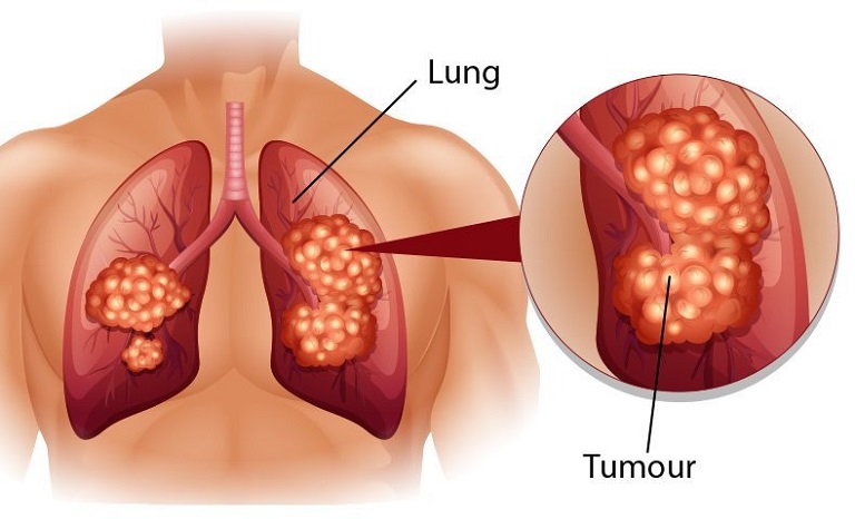 Tình trạng ho có thể dẫn đến biến chứng ung thư phổi rất nguy hiểm