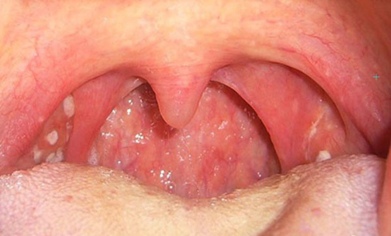 Nghẹt mũi có thể gặp ở một số bệnh nhân ung thư vòm họng