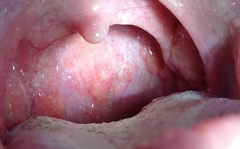 Bệnh có thể gây ra các biến chứng nguy hiểm như ung thư vòm họng