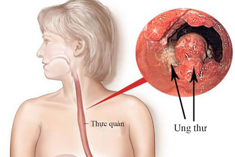 Viêm họng trào ngược có thể gây nên ung thư thực quản