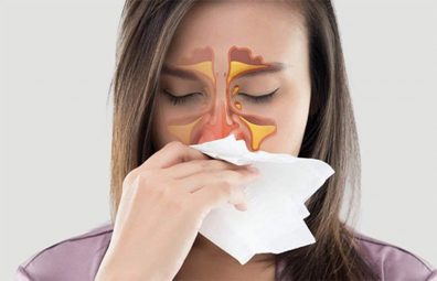 Viêm mũi xoang xuất tiết là một tình trạng nặng của bệnh viêm xoang, xoang có hiện tượng xung huyết và tiết dịch nhầy rất nhiều
