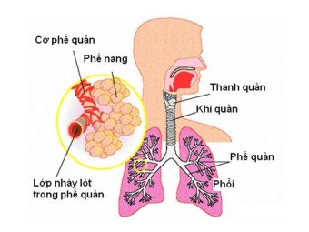 Viêm phế quản phổi là một bệnh lý hô hấp thuộc thể cấp tính, khởi phát do vi khuẩn, virus tấn công