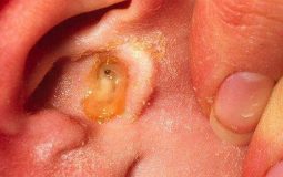 Viêm tai giữa ứ dịch là chứng bệnh nguy hiểm