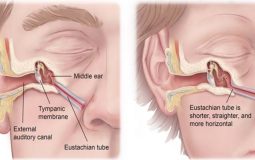 Bệnh viêm tai giữa xung huyết