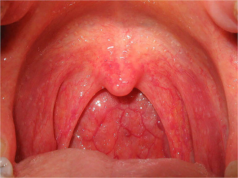 Vi khuẩn, virus xâm nhập gây viêm họng hôi miệng