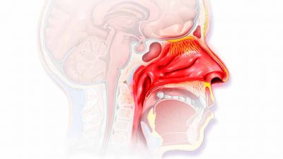 Khi bị viêm xoang hàm trên, người bệnh thường có hiện tượng chảy dịch nhày phía mũi hoặc họng