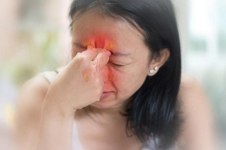 Viêm xoang trán xảy ra ở khu vực xoang trán nằm ở trên hốc mắt và giữa 2 lông mày