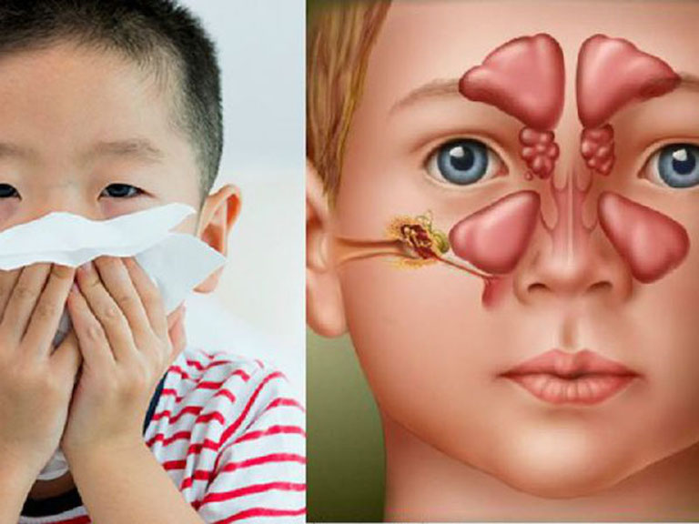 Điều trị viêm xoang cấp ở trẻ em cần được thực hiện sớm để bảo vệ sức khoẻ hệ hô hấp