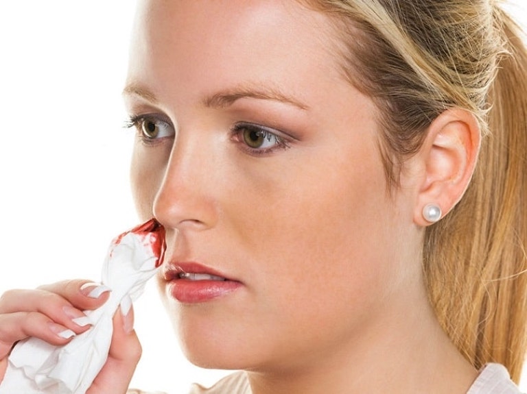 Viêm xoang chảy máu mũi là hiện tượng có thể gặp khi bạn bị mắc chứng viêm xoang