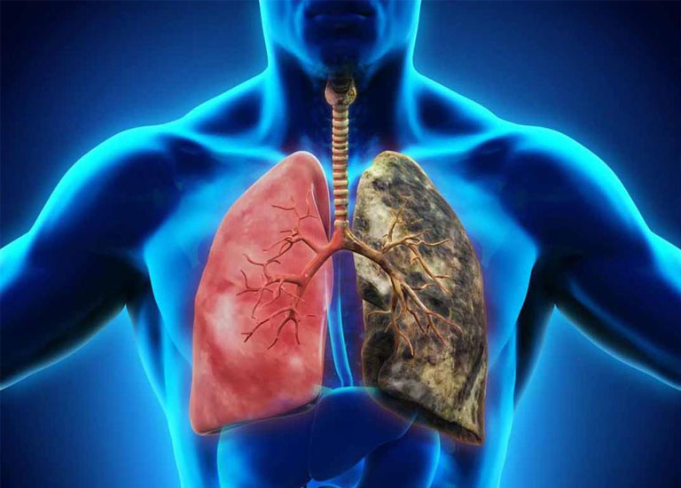 Các bệnh nền về phổi có thể gây nguy hiểm cho người mắc bệnh Covid - 19
