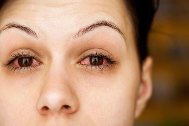 Viêm xoang hàm gây nhiều biến chứng ở mắt