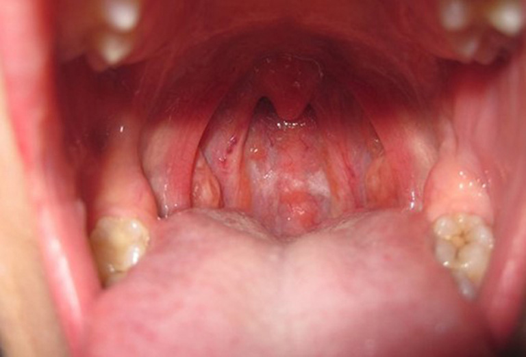 Có nhiều nguyên nhân gây bệnh viêm họng phù nề