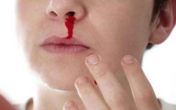 Viêm xoang cấp gây chảy máu mũi