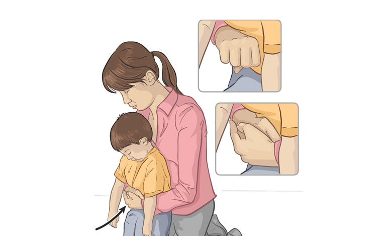 Cách xử trí dị vật ở họng ở trẻ lớn